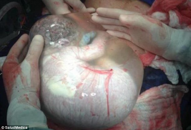 amniotic-sac